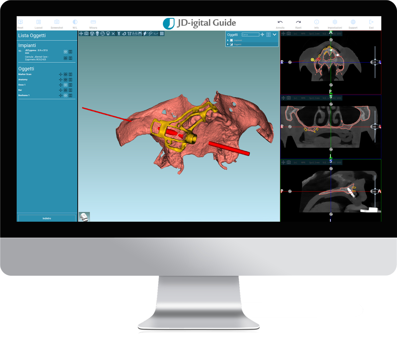 Całkowicie sterowana operacja wszczepienia implantu jarzmowego