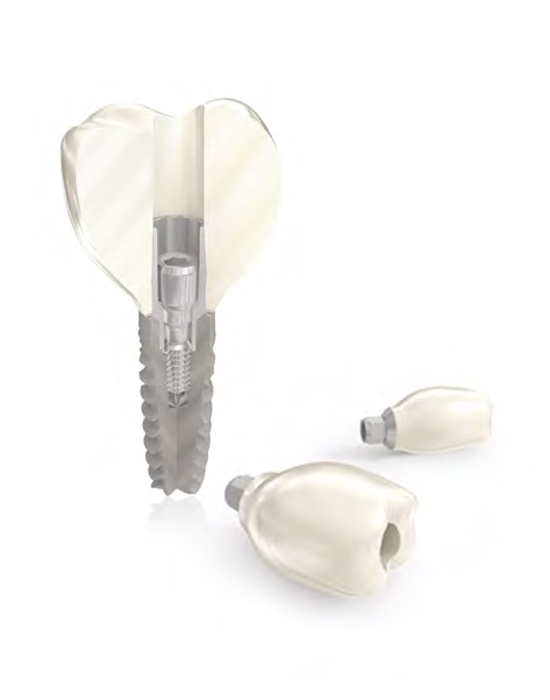 KORONA IMPLANTOWA JDLAB