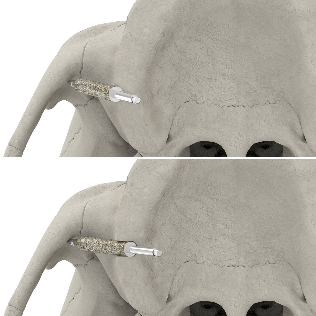 JDZygoArch Drill JDZygoArch Drill
